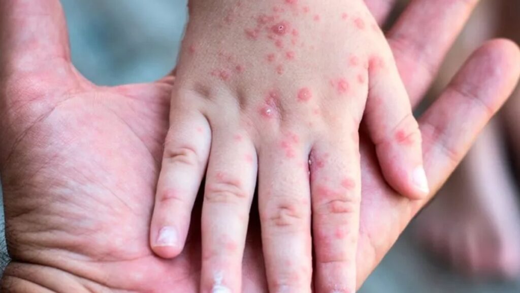 analizan-posible-caso-de-sarampion-en-nino-de-5-anos-en-arandas-jalisco-101650-1024x576